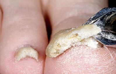 advanced stage of nail fungal infection