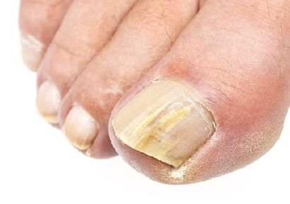 early stages of nail fungus infection