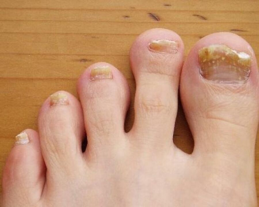 yellowness of the nail plate due to fungus