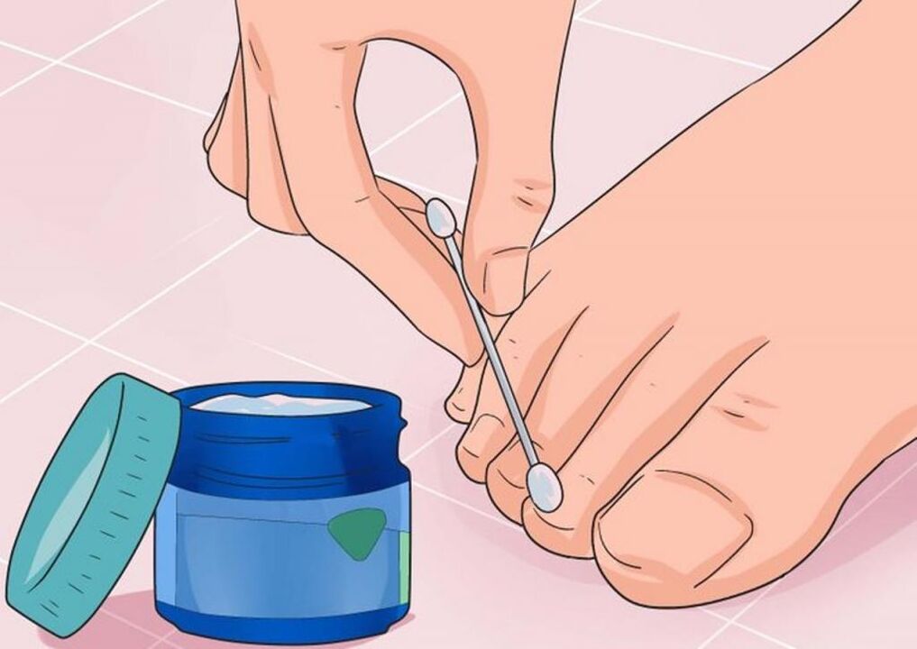 the use of ointments for the treatment of nail fungus