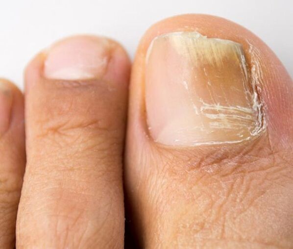 toenail fungal infections