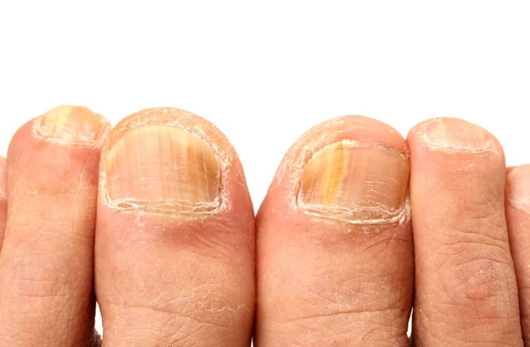 causes of toenail fungus