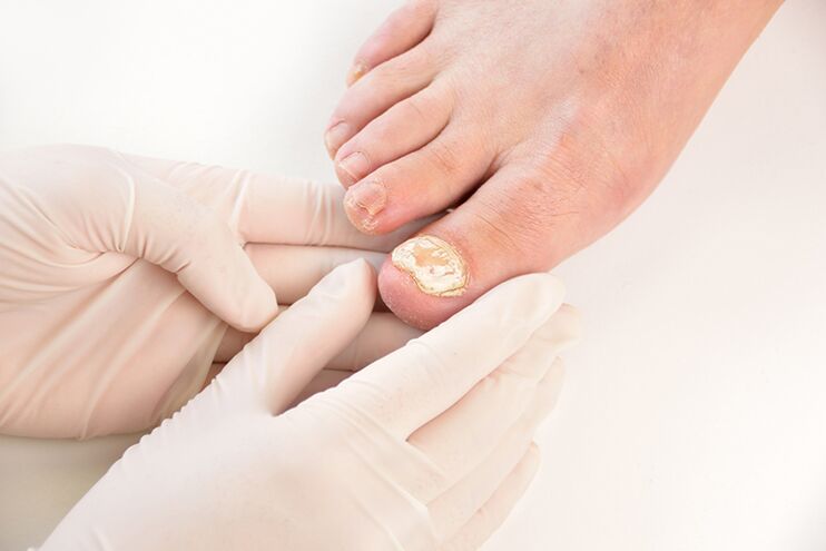 Before prescribing treatment, the doctor needs to diagnose toenail fungus