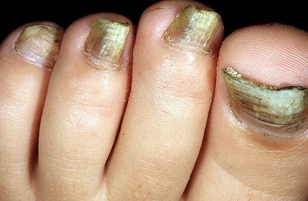 advanced stages of toenail fungus