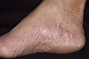 toenail fungus symptoms