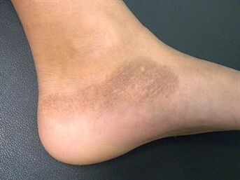 Mycosis of the feet is accompanied by a change in skin color