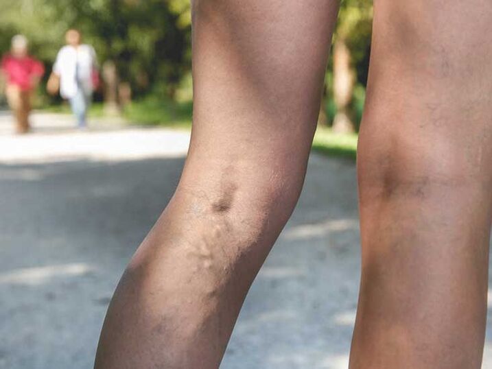 Varicose veins are a risk factor for foot fungus infection