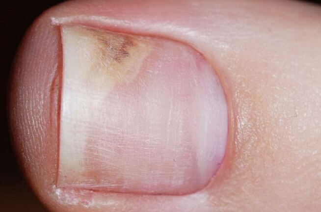 Signs of onychomycosis in the early stages - lack of shine, gaps between the nail and the bed