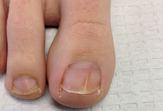 Visual manifestations of toenail fungus in the early stages