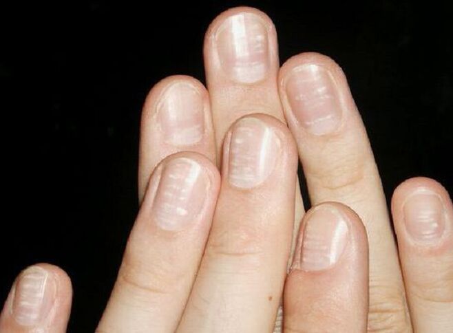 White spots on the nails are a sign of fungal growth