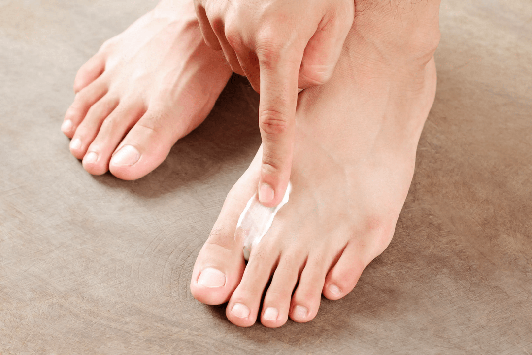 apply antifungal ointment on the skin of the feet