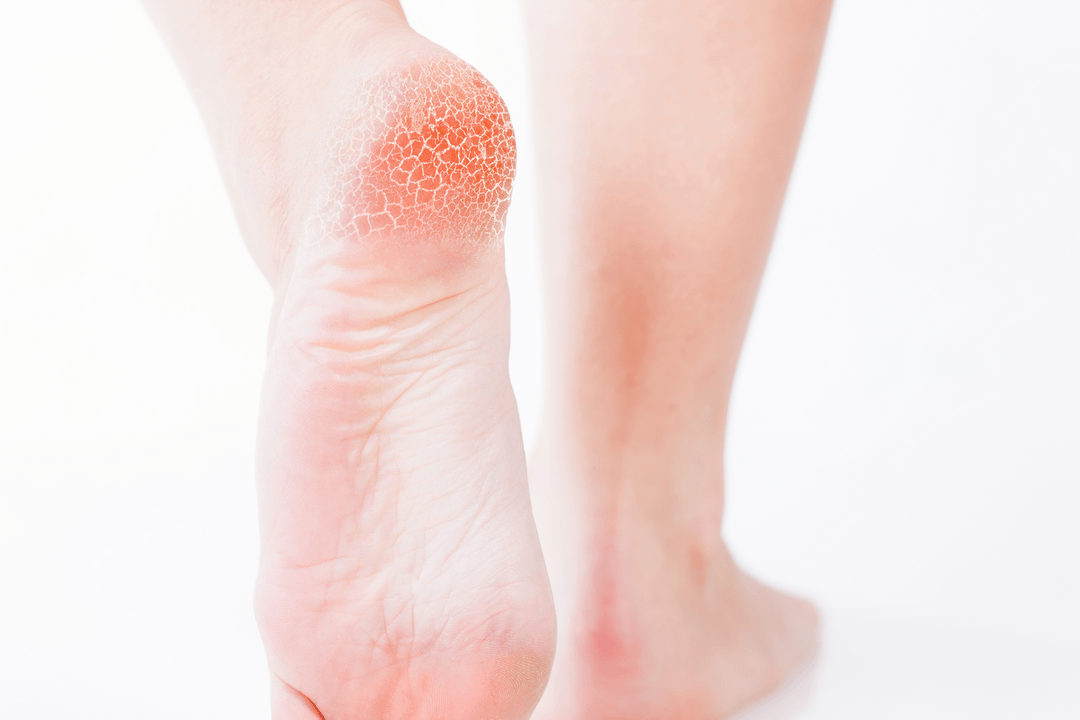 early stage foot fungus treatment