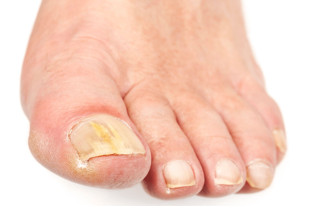 fungal infection of the nail plate
