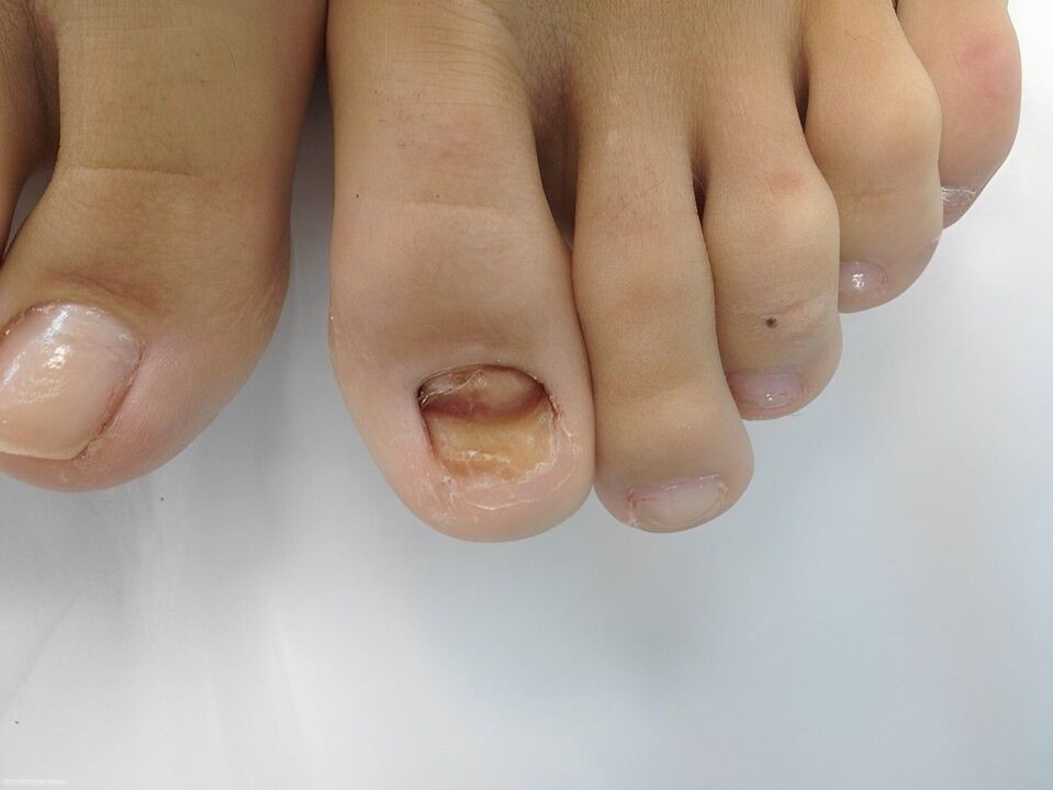 fungal nail disease