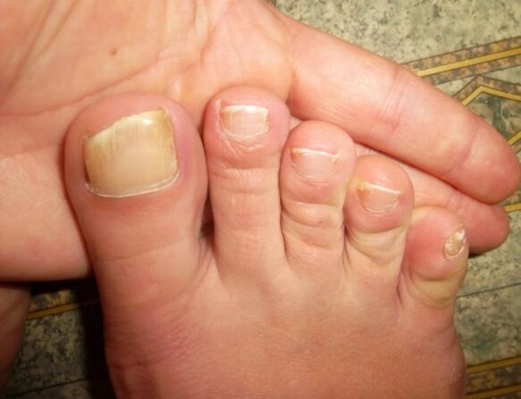 Fungus on large nails