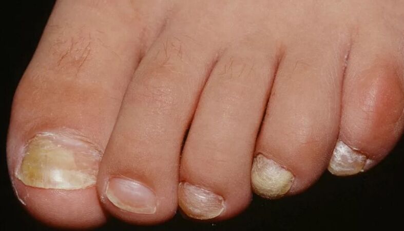 Nail fungus in the thumb