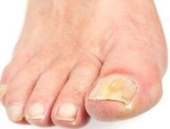 After bathing, the affected nails are easier to remove