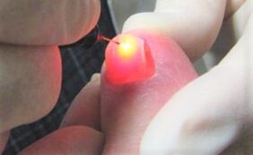 Nail fungal treatment with laser