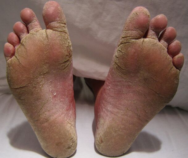 The defeat of mycotic legs