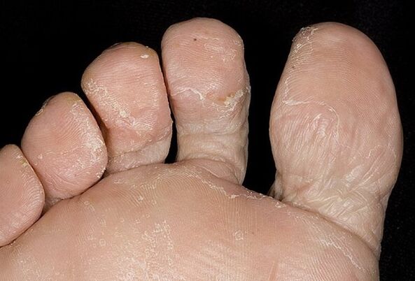 The type of foot fungus