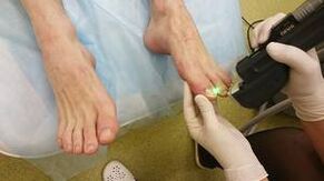 Fungal hardware treatment