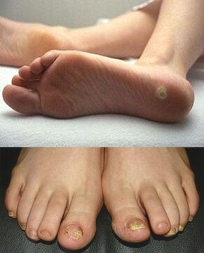 Fungus on the feet