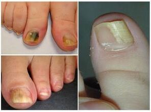 Like what fungus on nails