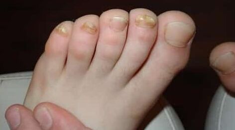 Almost all fingers are affected by fungus