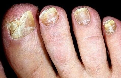 Nails collapsed from fungus
