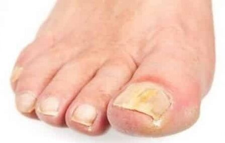 The early stages of fungus in the toenails