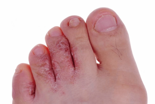 Advanced mycosis level