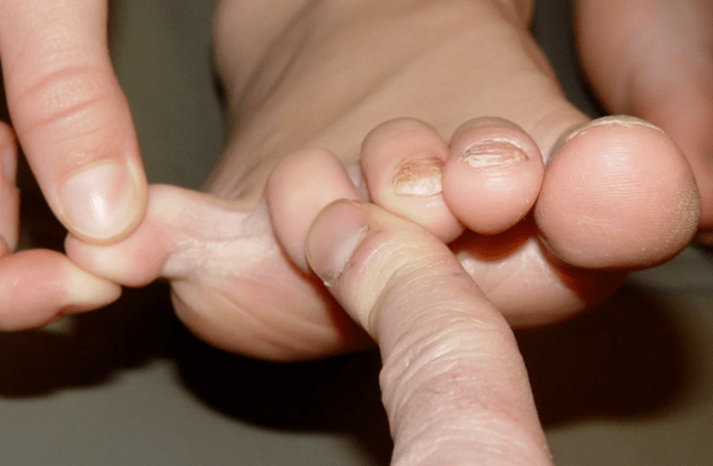 Fungus between fingers