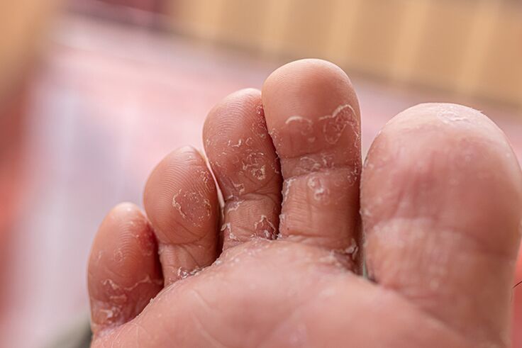 Fungus between fingers