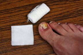 Compress with apple cider vinegar for fungal treatment