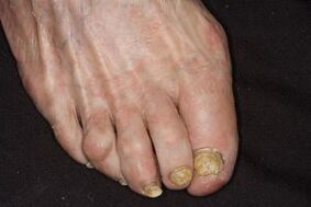 Nail fungus treatment on apple cider vinegar feet