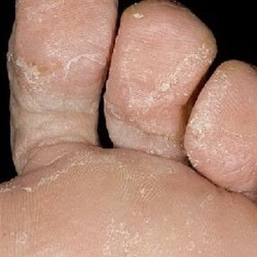 stage of nail fungus
