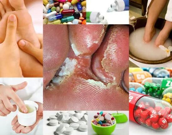 Methods of interdigital mycosis and treatment