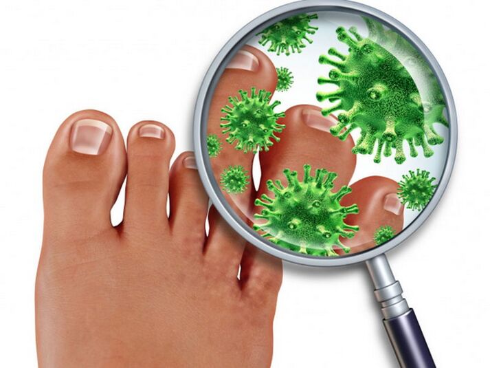 fungal infection