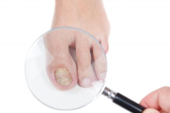 stage and stage of development of fungus on toenails