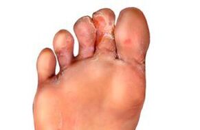 fungus between the fingers