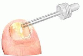 Apply drops of medicine on the nails affected by the fungus