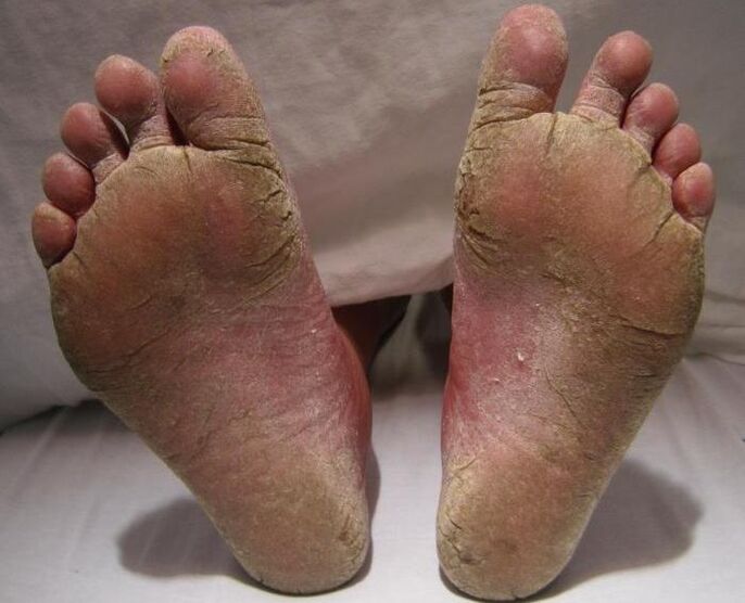 squamous-hyperkeratic fungus on the feet