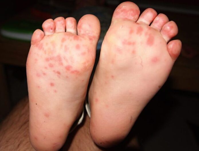 vesicular fungus on the feet