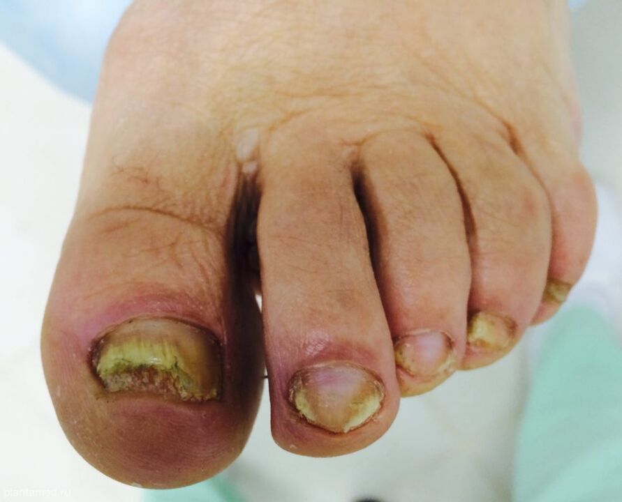 Severe toenail deformation is a sign of the third advanced stage of the fungus