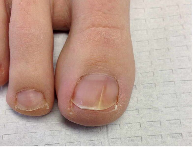 Stripes and spots on the nail of the big toe during the first stage of fungal development