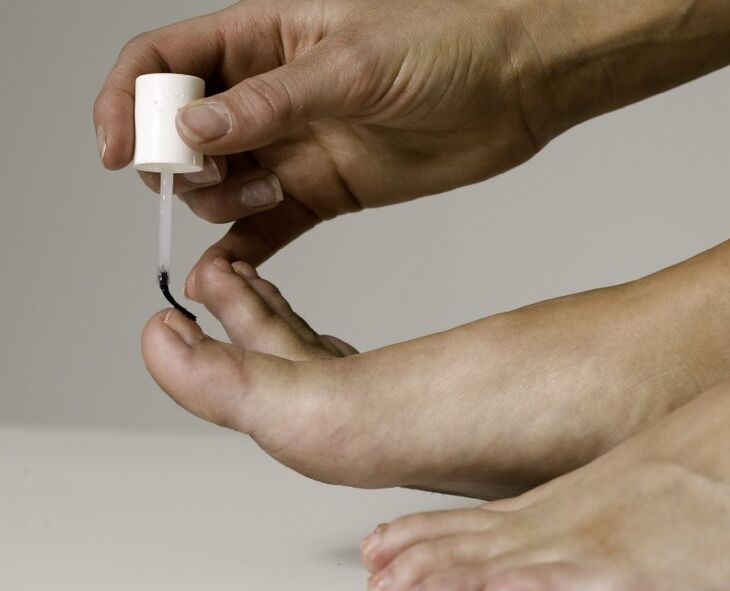 The use of medical varnish for the treatment and prevention of onychomycosis on the big toe