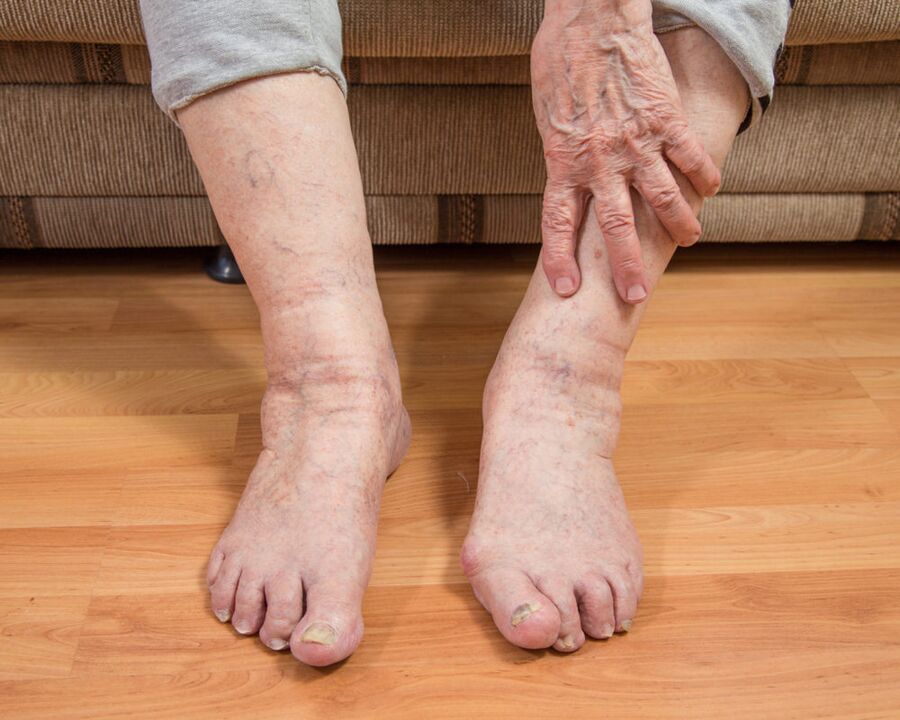 To prevent the spread of fungal microspores, do not walk barefoot in the house.