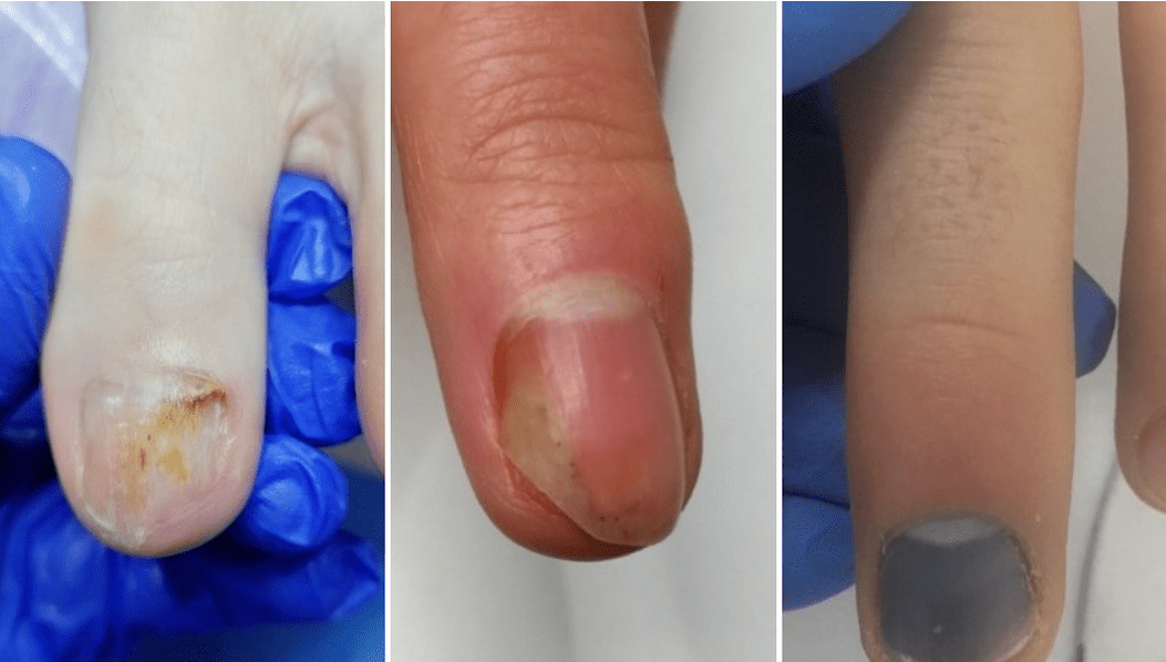 what is nail fungus like